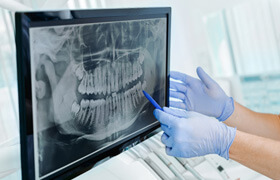 dentist with blue gloves pointing to xray with pen