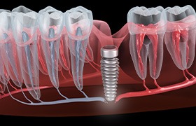 Illustration of a failed dental implant in Beverly, MA