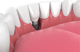 Illustration of a failed dental implant in lower jaw