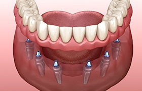 3D illustration of implant denture  