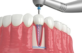 A digital image of a root canal in Beverly