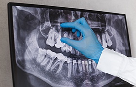 Dental X-ray showing tooth needing treatment